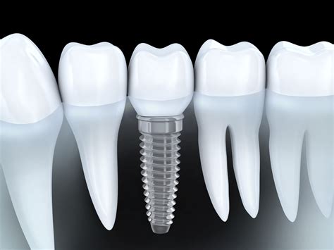 affordable teeth implants options